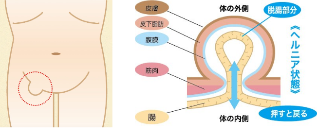 鼠径ヘルニアのふくらみの位置と腸が突出する仕組みを示す図