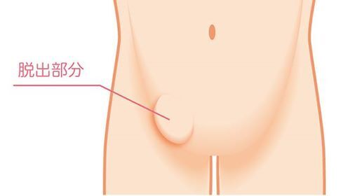 鼠径ヘルニアの症状｜腸が足の付け根から飛び出して膨らむ状態の図
