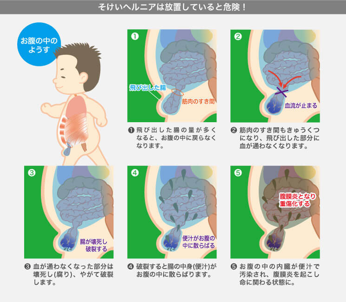 鼠径ヘルニアの症状が進行し嵌頓を起こすまでの仕組みを示したイラスト