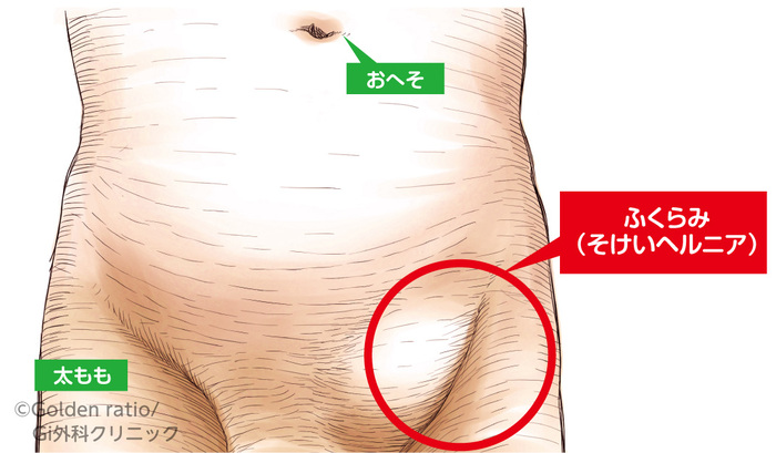鼠径ヘルニア・脱腸の治療方法