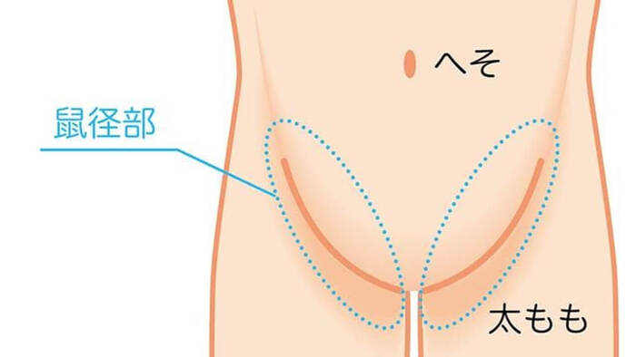 鼠径部にしこり？それ脱腸（鼠径ヘルニア）かもしれません｜押すと痛い原因と受診の目安を専門医が解説